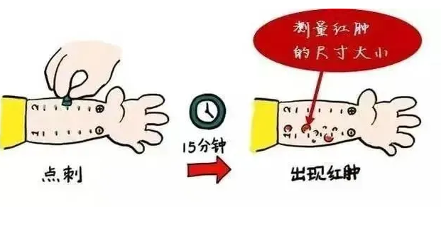 过敏疾病莫慌张，皮肤点刺找真凶！